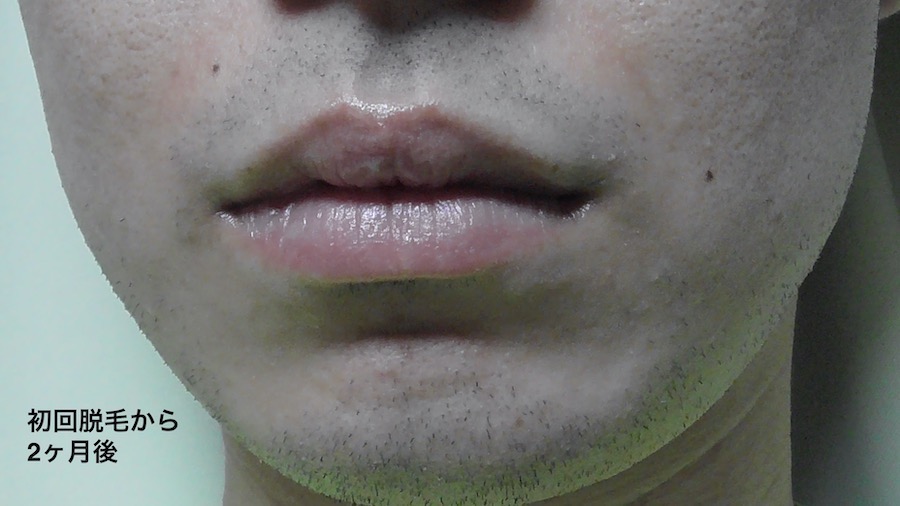 初回から2ヶ月後のヒゲ
