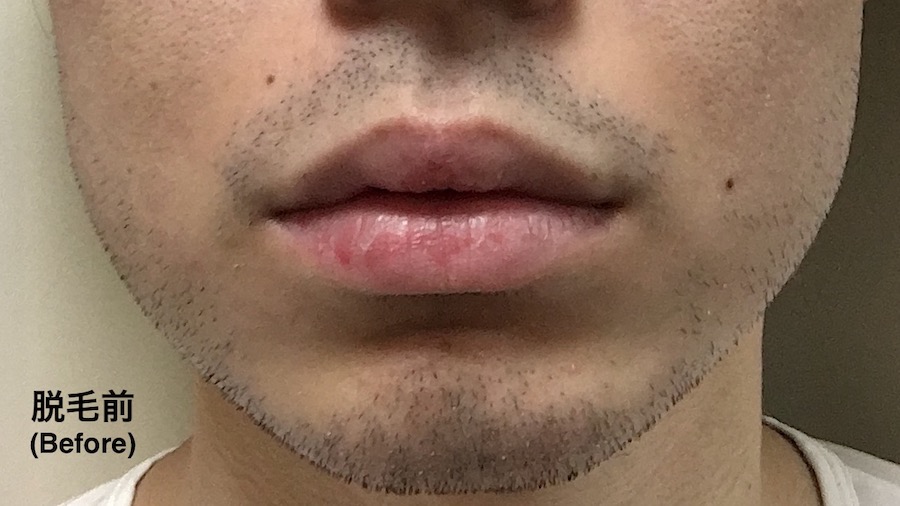 脱毛前のヒゲ(Before)