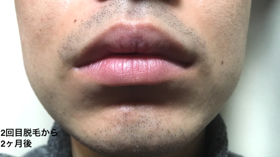 2回目から2ヶ月後のヒゲ