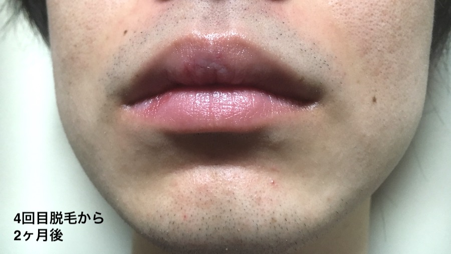 4回目脱毛から2ヶ月後のヒゲ