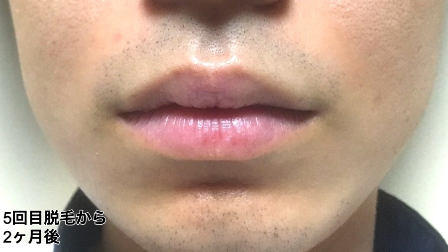 5回目脱毛から2ヶ月後ひげ