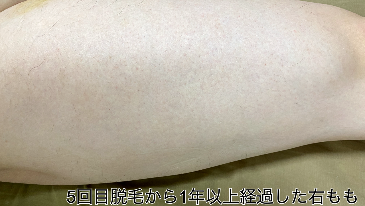 5回目脱毛から1年経過した右もも