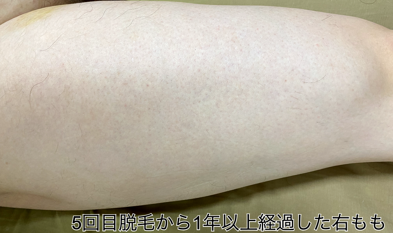 5回目脱毛から1年経過した右もも