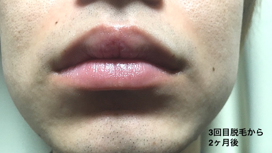 3回目脱毛から2ヶ月後のヒゲ