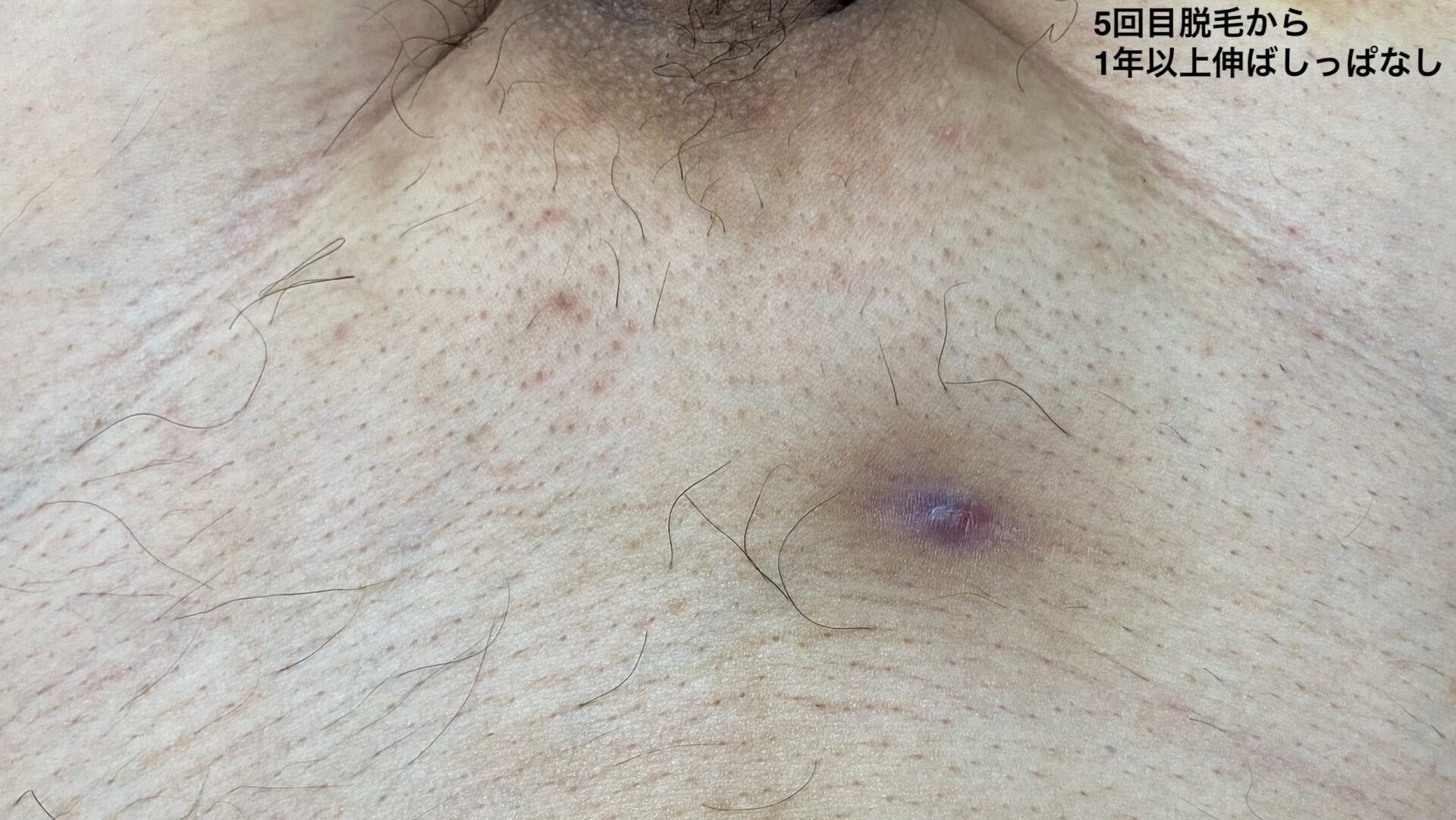 5回目脱毛vライン