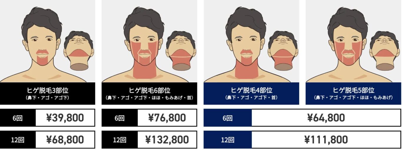 ゴリラクリニックのヒゲ脱毛料金